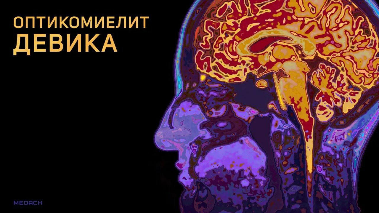 Оптиконейромиелит девика. Заболевания спектра оптиконейромиелита. Заболевания спектра оптиконейромиелита. Оптикомиелит болезнь. Болезнь девика.