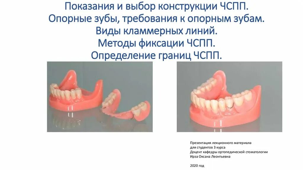 Съемный пластиночный протез показания. Частичный съемный пластиночный протез. Фиксация частичных съемных пластиночных протезов.