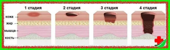 Через 1 стадии. Отслойка эпидермиса пролежни. Четвертая стадия развития пролежней.