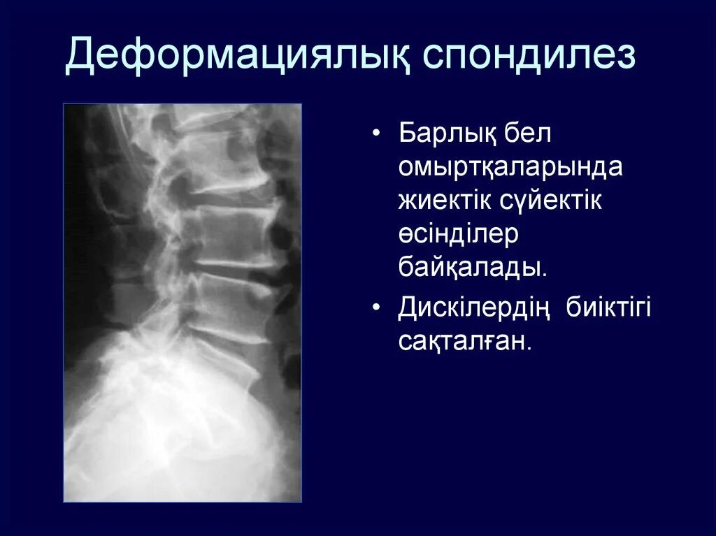 Деформирующий спондилез рентген. Деформирующий спондилез грудного отдела позвоночника рентген. Деформирующий спондилез шейного отдела рентген. Спондилез шейного отдела рентген. Начальный спондилез