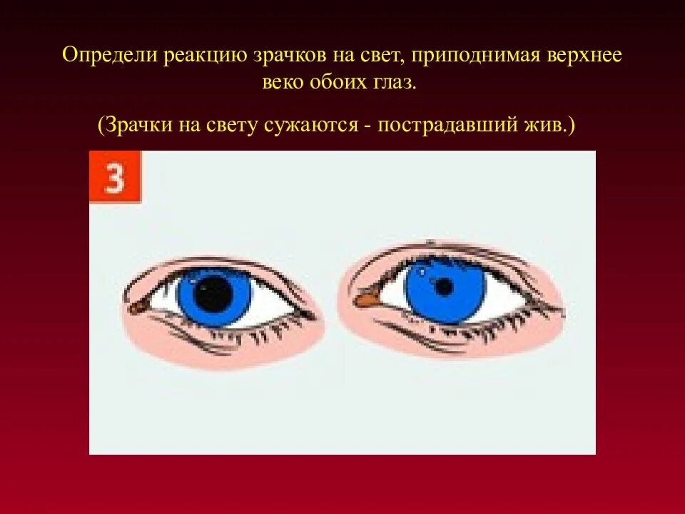 Выявление реакции зрачка на свет. Оценка реакции зрачков на свет. Нормальная реакция зрачка на свет. Отсутствие реакции зрачка на свет признак отсутствия