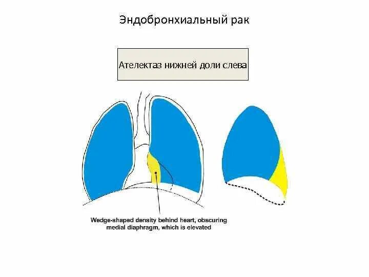 Ателектаз средней доли схема. Ателектаз нижней доли левого легкого на кт. Ателектаз нижней доли кт. Схемы ателектазов долей легких. Ателектаз левой доли легкого