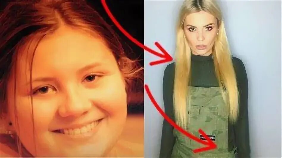 Анна шульгина до и после пластики Анна Шульгина до и после похудения на 25 килограмм (Фото) Умница-Красавица