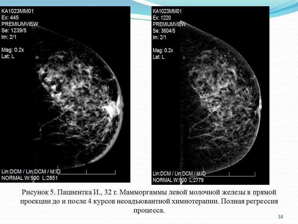 Химия терапия при онкологии молочной железы. Химия терапия при онкологии молочной железы 1 стадия. Химия терапия при онкологии молочной железы 2 степени. Химия терапия при онкологии молочной железы последствия. Как уменьшить опухоль