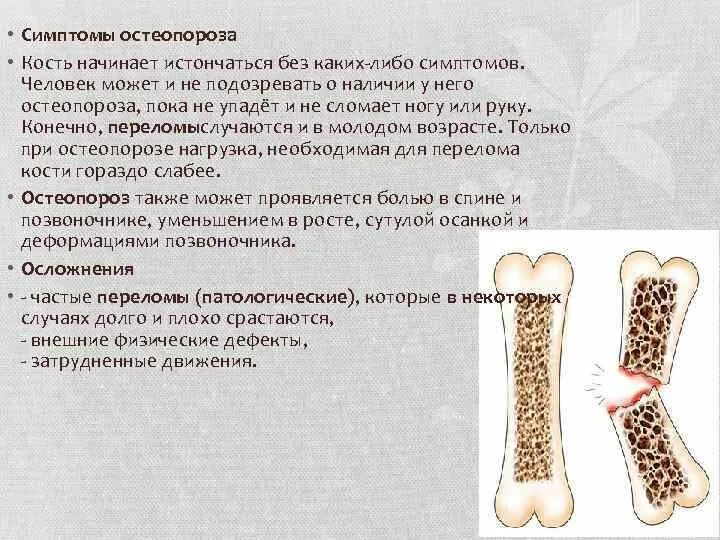 Почему кости легкие. Остеопоретическая кость. Остеопороз симптомы. Признаки остеопороза Кост. Остеопороз костей симптомы.