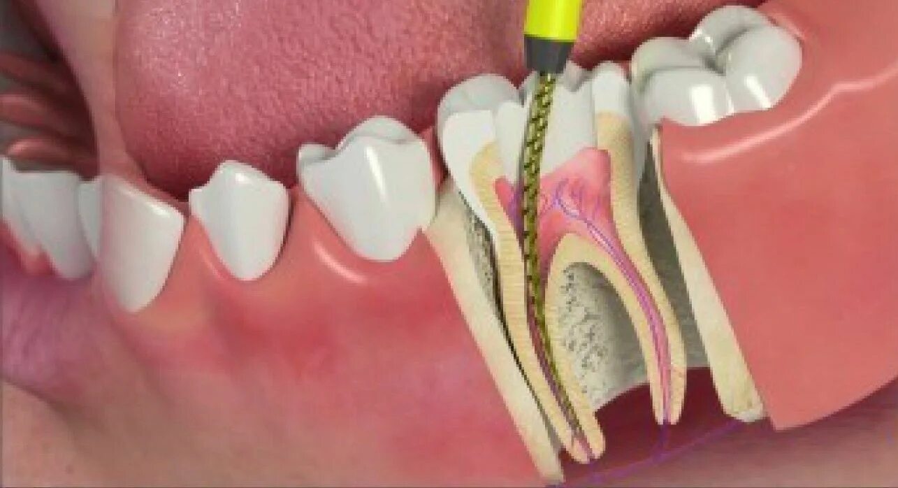 Почему открывают зуб. Эндодонтическое перелечивание зубов. Периодонтит эндодонтия.