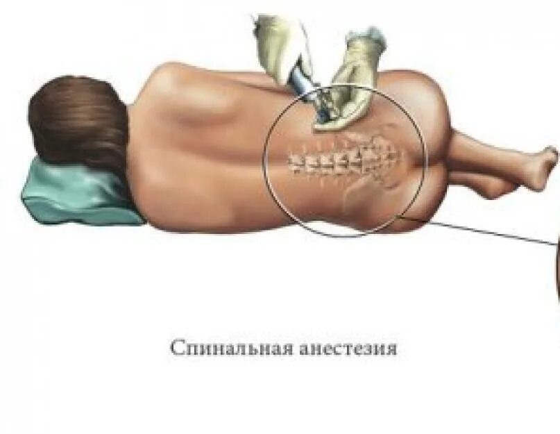 Как делают спинальную анестезию