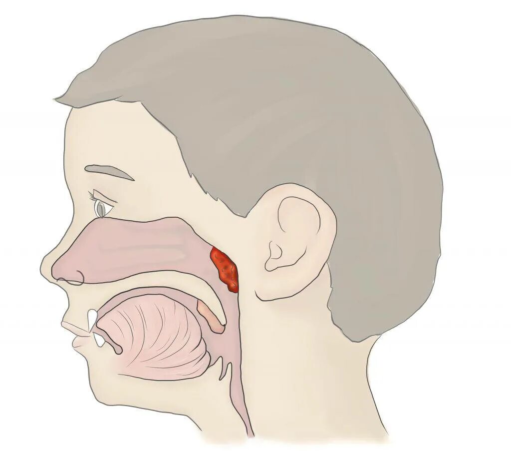 Аденоиды носоглоточные миндалины. Носоглотка воспаление аденоиды. Анатомия носоглотки аденоиды. Что такое аденоиды в носоглотке у ребенка. Аденоидные вегетации 1