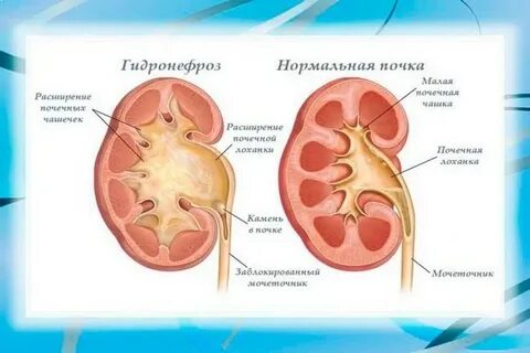 Гидронефроз почек что это такое