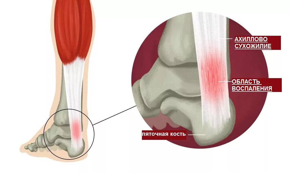 Боль ахиллова сухожилия