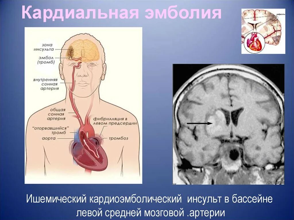 Ишемический инсульт головного мозга в бассейне левой СМА. Ишемический инсульт в каротидном бассейне. ОНМК В правой средней мозговой артерии клиника. Ишемический инсульт при поражении средней мозговой артерии. Тромбоз мозговых сосудов