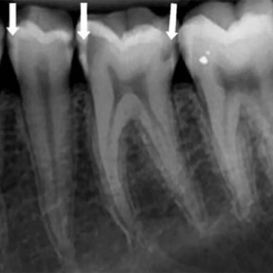 Снимок зубов видное. Гранулематозный периодонтит рентген зуба. Периапикальный периодонтит.