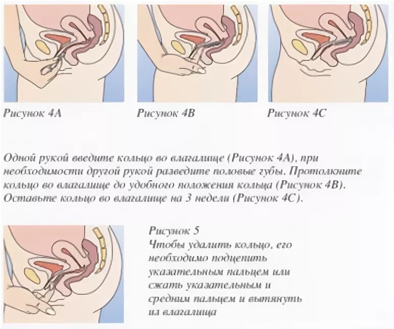 Как правильно вставлять утрожестан. Препарат кольцо новаринг. Новаринг кольцо кольцо вагинальное. Кольцо новаринг во влагащение. Введение кольца новаринг.