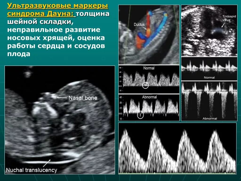 Уз маркеры. УЗИ критерии синдрома Дауна. Маркеры синдрома Дауна на УЗИ. Ультразвуковые маркеры. Симптомы синдрома Дауна на УЗИ.