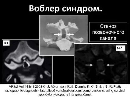 Что такое стеноз позвоночного канала