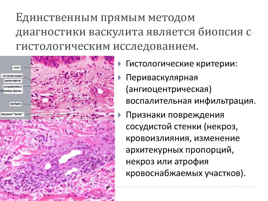 Гистология диагнозы. Кожный васкулит гистология. узелковый полиартериит микроскопия. биопсия кожи при геморрагическом васкулите. патологическая анатомия при геморрагическом васкулите.
