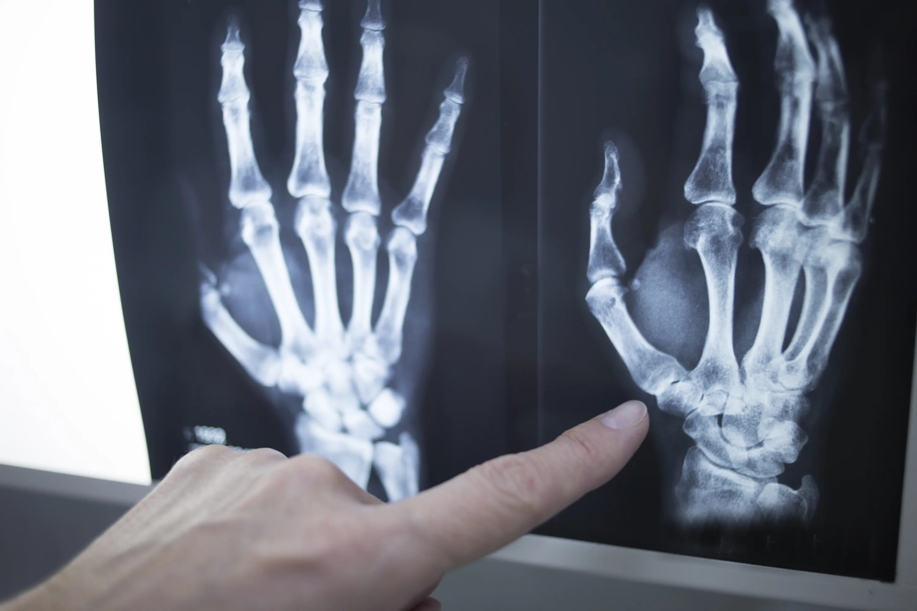 Рентген кисти перелом пястной кости. Перелом пальца на руке рентген. Перелом большого пальца на руке рентген. Реншен большого пальца руки.