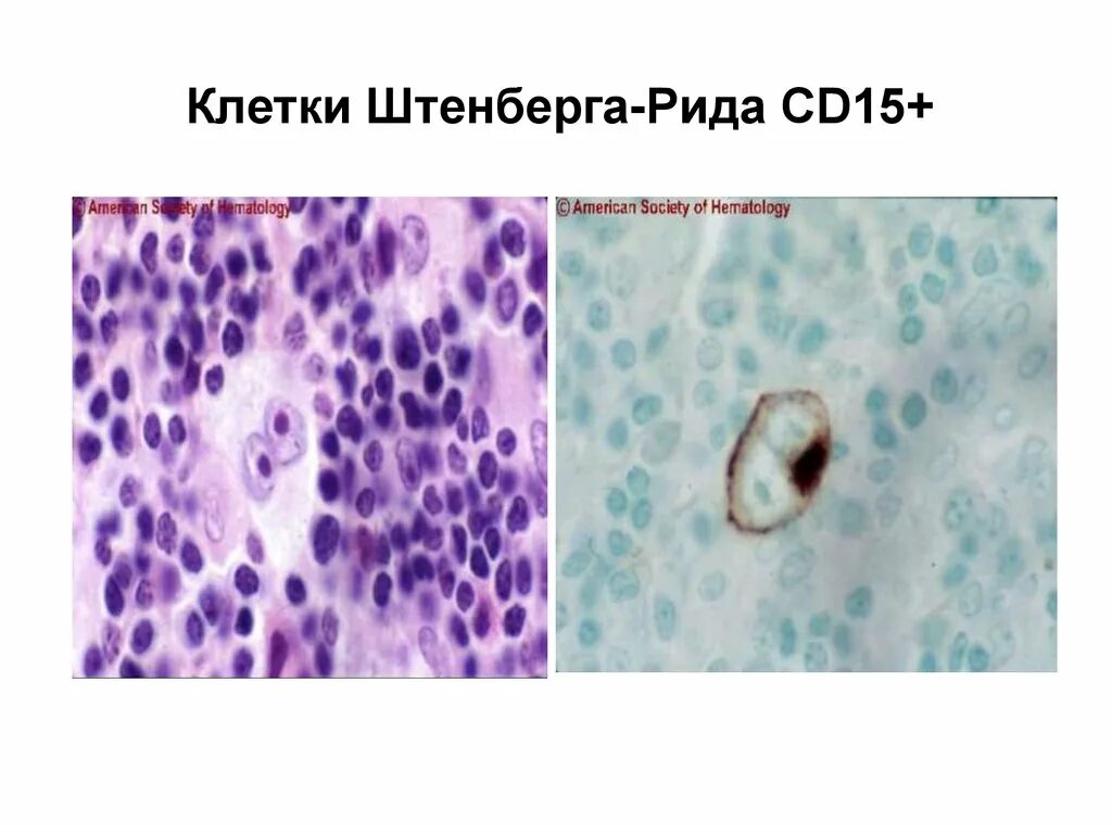 Клетки рида. Клетки рид-березовского-штернберга. Клетки рида березовского штернберга. Клетки рида березовского штернберга. Клетки рида березовского штернберга.