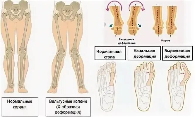 Деформация стопы у ребенка 10 лет. Вальгусная девиация коленного сустава. варусная девиация коленного сустава. варусная и вальгусная деформация коленного сустава. вальгусное отклонение голени.