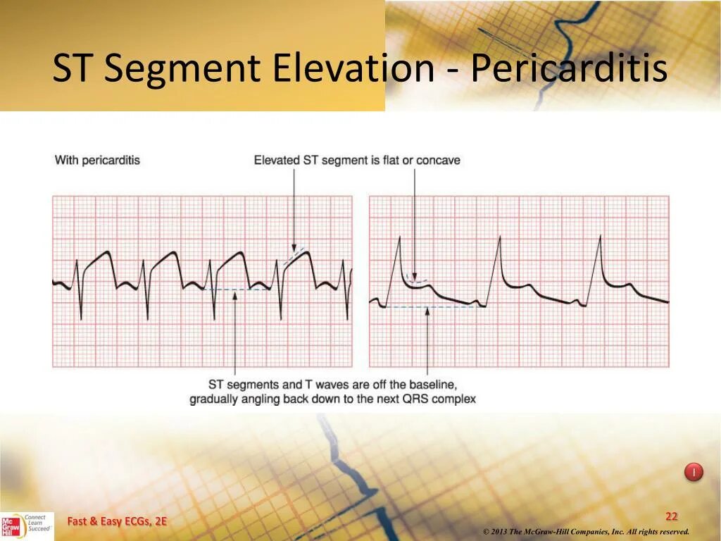 Сегмент s t. Элевация сегмента st. перикардит st сегмент. st segment elevation. перикардит у ребенка 1 года.