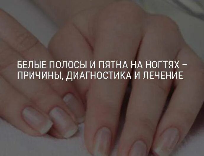 (лейконихия) лейконихия ногтей. белые крапинки на ногтях рук. белые пятна на ногтевой пластине. лейконихия белые пятна на ногтях. каналиформная ониходистрофия.