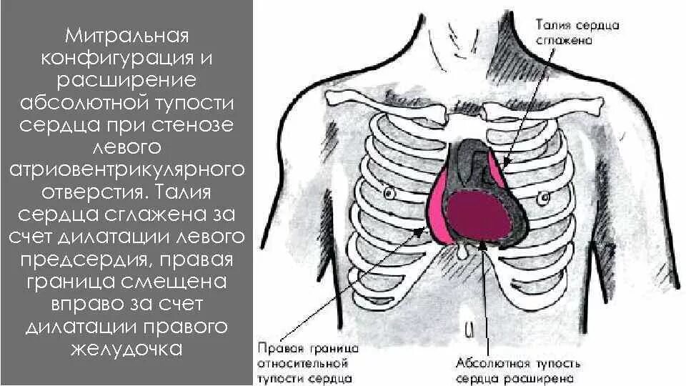 Абсолютная тупость сердца при митральной недостаточности. Митральная конфигурация сердца при митральном стенозе. Митральная конфигурация конфигурация сердца. Расширение границ относительной сердечной тупости.