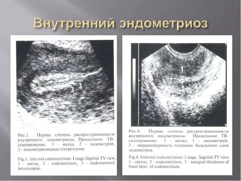 Признаки внутреннего эндометриоза на узи. Эндометриоз эндометрия УЗИ. Эндометриоз 1 степени на УЗИ.