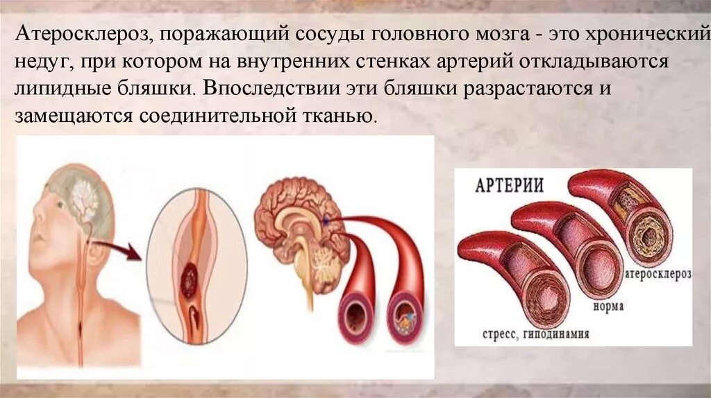 Бляшка в головном мозге