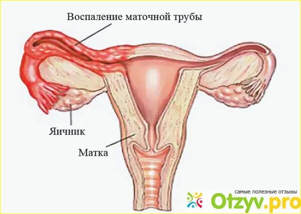 Воспаление внутренней оболочки матки. Сальпингоофорит (аднексит). Воспаление маточных труб. Воспаление маточных труб и яичников.