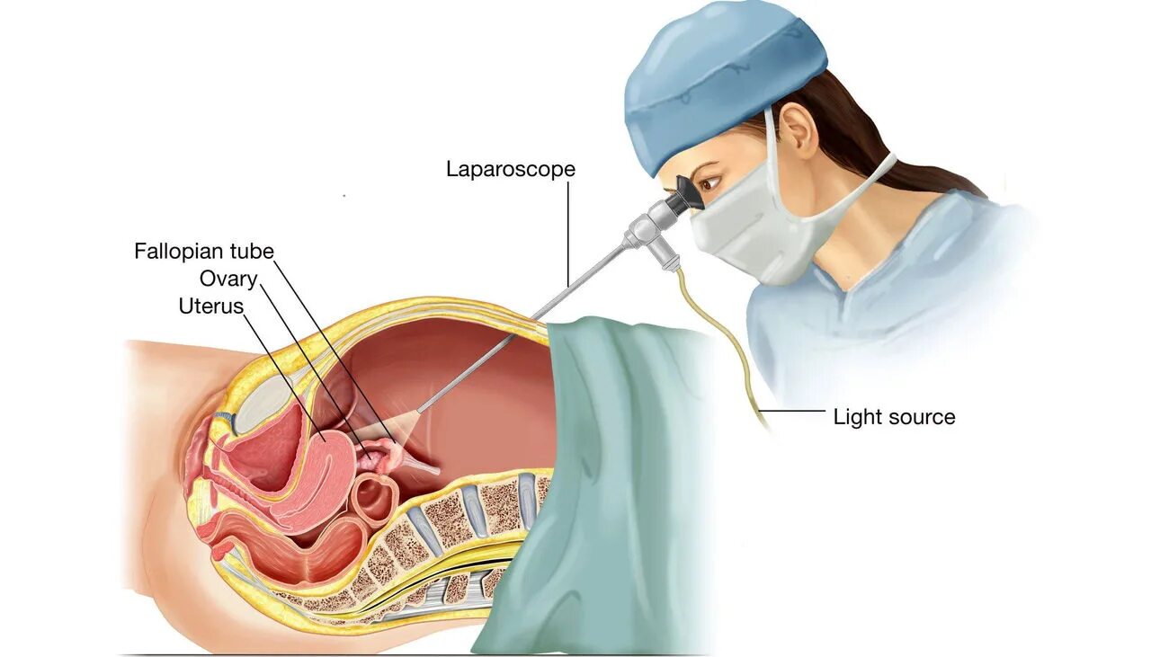Накачали матку. Перекрут кисты яичника лапароскопия. Лапароскопия в гинекологии. Лапароскопическая операция в гинекологии. Операция лапароскопия в гинекологии.