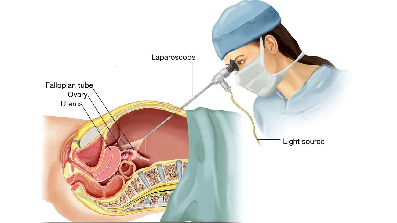 Как удлинить матку. Перекрут кисты яичника лапароскопия. Лапароскопия в гинекологии. Лапароскопическая операция в гинекологии. Операция лапароскопия в гинекологии.