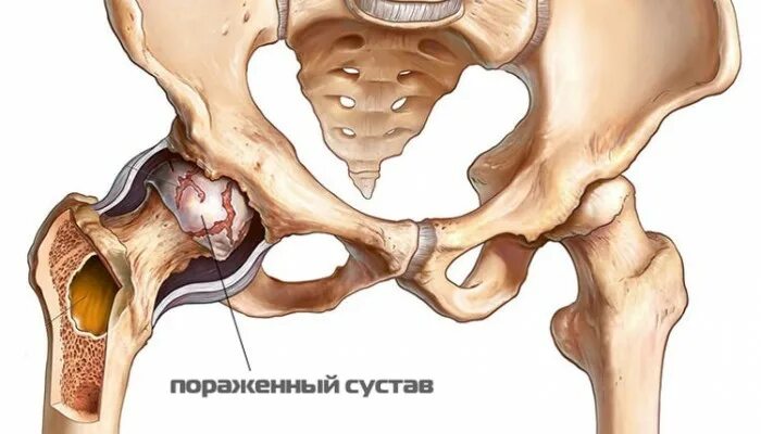 Можно ли лечить тазобедренный сустав. Остеоартроз коксартроз тазобедренного сустава. диспластический коксартроз. артрит коксартроз тазобедренного.