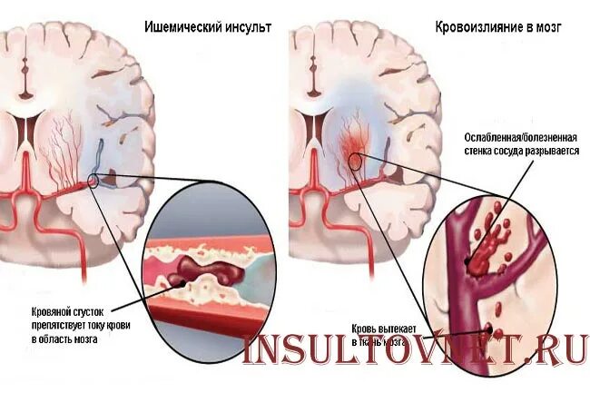 Геморроидальное кровоизлияние в мозг. Кровоизлияние при инсульте.