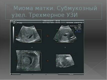 Миоме 6