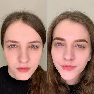Разные глаза коррекция