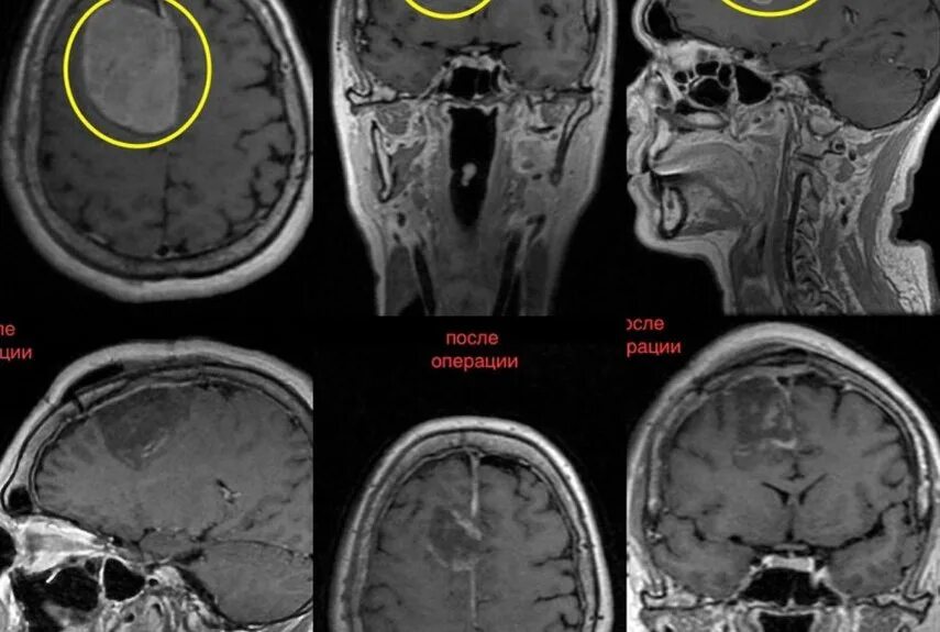 Ольфакторная менингиома. Операция менингиома головы. После операции менингиомы головного мозга