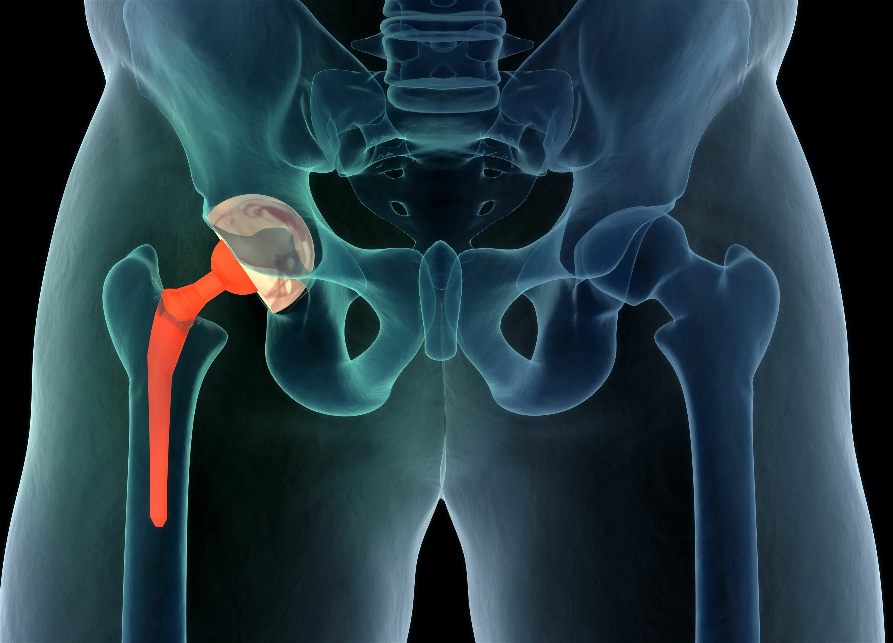 Гемиартропластика тазобедренного сустава. Эндопротезирование тазобедренного сустава. Эндопротезирование тазобедренного сустава 3 д. Эндопротез тазобедренного сустава Джонсон и Джонсон.