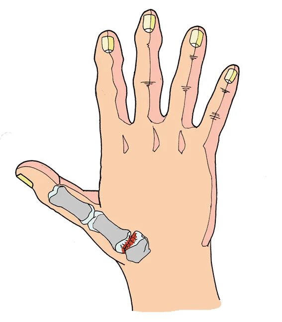 Болят большие пальцы рук лечение. Ризартроз большого пальца левой руки. Ризартроз безымянного пальца. Артроз большого пальца руки. Основание большого пальца руки.