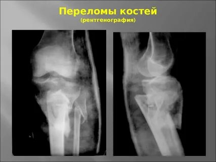 Основы травматологии