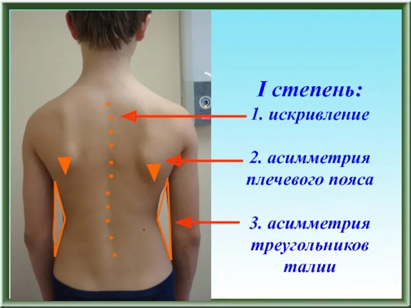 Асимметрия плеч. Сколиоз позвоночника 2 степени реберный горб. Плечевая асимметрия. Асимметрия плеч. Высокая степень асимметрии плеч.