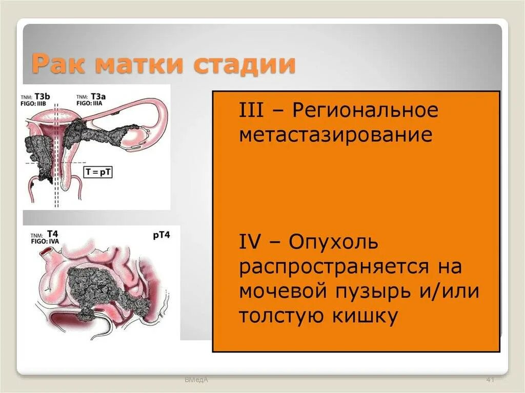 Сколько живут после рака матки. Карцинома матки стадии. Опухоли тела матки стадии.