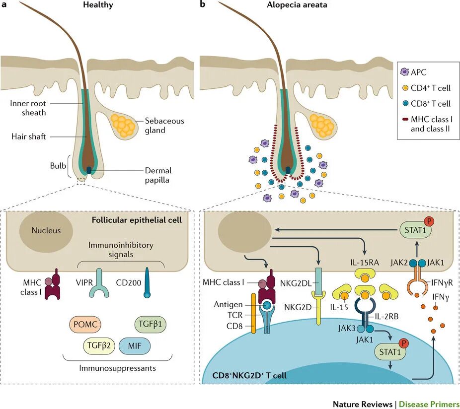 Nature reviews. Nature Reviews disease primers. Comparison of alopecia Areata.