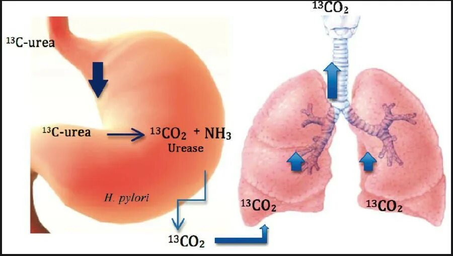 Urea Breath Test. Дыхательный тест с мочевиной. 13с-уреазный дыхательный тест. Carbon urea Breath Tests.