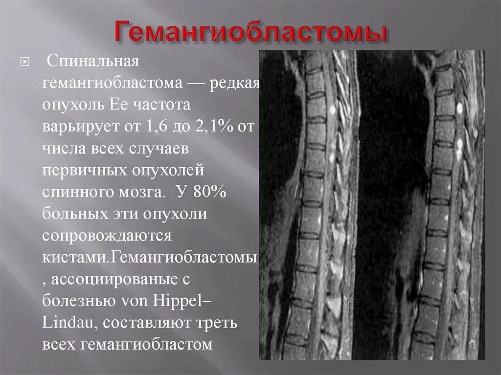 Гемангиобластома спинного мозга мрт. Опухоль спинного мозга мрт. Эпендимома спинного мозга. Эпендимома спинного мозга мрт.