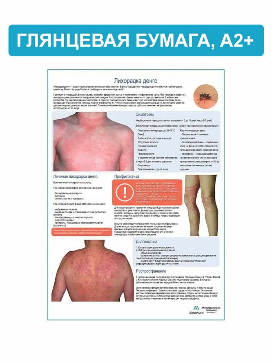 Лихорадка денге болезнь. Лихорадка денге симптомы. Лихорадка денге симптомы. Лихорадка денге симптомы. Геморрагическая форма лихорадки денге.