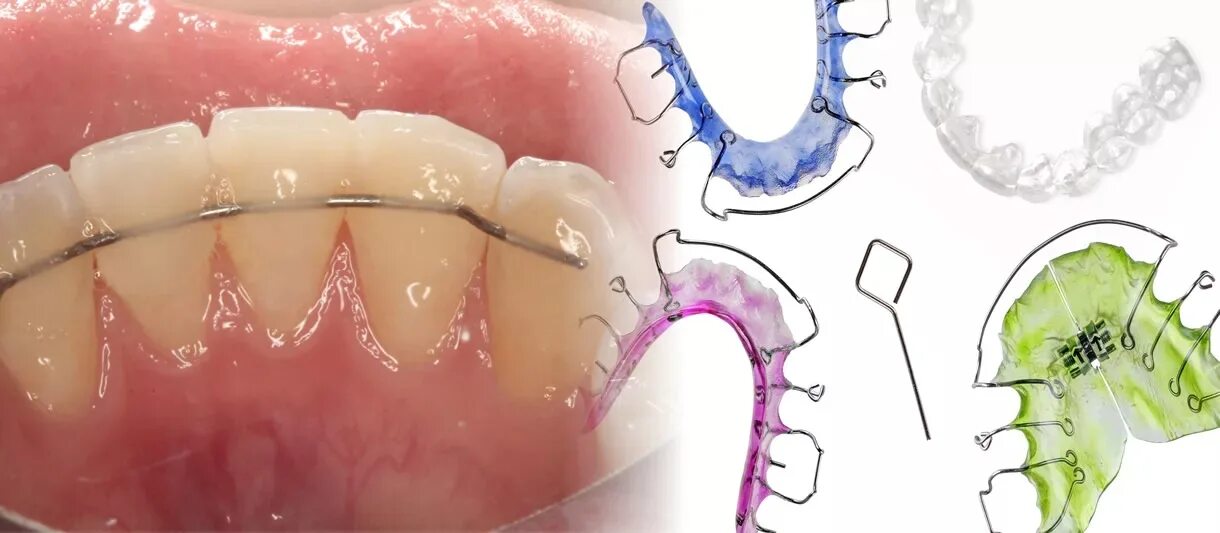 Ретейнер лингвальный 260-032. Ретенционные аппараты ретейнер. Ретейнеры в стоматологии. Зачем нужные пластины
