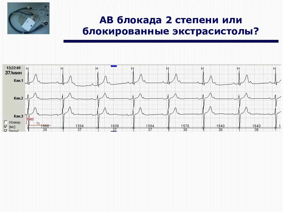 Блокированные предсердные экстрасистолы на ЭКГ. Блокированная суправентрикулярная экстрасистолия ЭКГ. Предсердная экстрасистолия на ЭКГ. ЭКГ Холтер АВ блокада. Блокада экстрасистолы