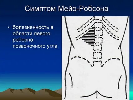 Мейо робсона