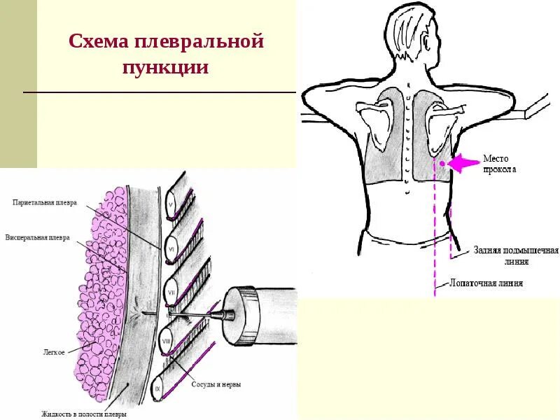 Техника выполнения плевральной пункции. Пункция плевральной полости схема. Методика выполнения пункции плевральной полости. Точка пункции плевральной полости при пневмотораксе. Точки для пункции плевральной полости у детей.