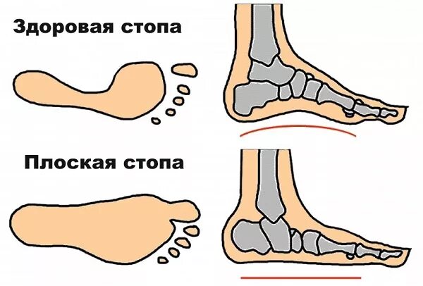 Изменения стопы. Плоскостопие это уплощение сводов стопы. плоскостопие поперечного свода стопы. стопы с продольным плоскостопием. продольный свод стопы плоскостопие.